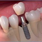 Плюсы современных имплантатов для зубного протезирования