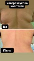 Ультразвукова кавітація (ліпосакція та схуднення)