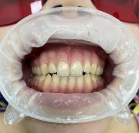 Професійна чистка зубів ( професійна гігієна ротової порожнини)